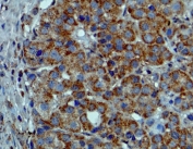 IHC staining of formalin fixed and paraffin embedded melanoma tissue sections with recombinant BRAF V600E antibody. HIER: steam section in pH6 citrate buffer for 20 min and allow to cool prior to testing.