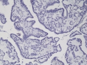 IHC staining of formalin fixed and paraffin embedded thyroid carcinoma tissue with recombinant BRAF V600E antibody. Allele specific PCR validated to be negative for BRAF V600E. HIER: steam section in pH6 citrate buffer for 20 min and allow to cool prior to testing.