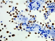 ICC staining of formalin fixed and paraffin embedded human WiDr cells (400X, Positive) with recombinant BRAF V600E antibody. HIER: steam section in pH6 citrate buffer for 20 min and allow to cool prior to testing.