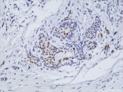 IHC staining of formalin fixed and paraffin embedded human breast cancer tissue using recombinant Estrogen Receptor alpha antibody at a 1:100 dilution. HIER: steam section in pH6 citrate buffer for 20 min and allow to cool prior to testing.