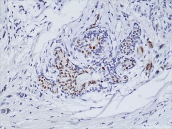 IHC staining of formalin fixed and paraffin embedded human breast cancer tissue using