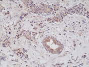 IHC staining of formalin fixed and paraffin embedded human breast cancer tissue using recombinant EGFR antibody at a 1:200 dilution. HIER: steam section in pH6 citrate buffer for 20 min and allow to cool prior to testing.