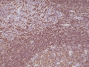 IHC staining of formalin fixed and paraffin embedded human tonsil tissue with recombinant CD45 antibody at a 1:200 dilution. HIER: steam section in pH6 citrate buffer for 20 min and allow to cool prior to testing.