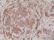 IHC testing of formalin fixed and paraffin embedded human breast cancer tissue with recombinant ACTN4 antibody at 1:200 dilution. HIER: steam section in pH6 citrate buffer for 20 min and allow to cool prior to staining.