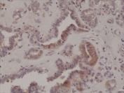IHC testing of formalin fixed and paraffin embedded human thyroid cancer tissue with recombinant phospho-EIF2A antibody at 1:200 dilution. HIER: steam section in pH6 citrate buffer for 20 min and allow to cool prior to staining.