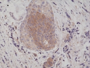 IHC testing of formalin fixed and paraffin embedded human breast cancer tissue with recombinant phospho-EIF2A antibody at 1:200 dilution. HIER: steam section in pH6 citrate buffer for 20 min and allow to cool prior to staining.
