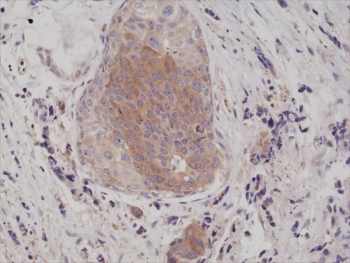 IHC testing of formalin fixed and paraffin embedded human breast cancer tissue with recombinant phospho-EIF2A antibody at 1:200 dilution. HIER: steam section in pH6 citrate buffer for 20 min and allow to cool prior to staining.