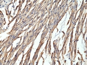IHC testing of formalin fixed and paraffin embedded human gastrointestinal stromal tumor tissue with recombinant CD34 antibody at 1:400 dilution. HIER: steam section in pH6 citrate buffer for 20 min and allow to cool prior to staining.