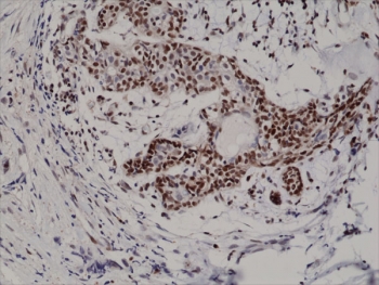 IHC testing of formalin fixed and paraffin embedded human breast cancer tissue with recombinant p27 antibody at 1:200 dilution. HIER: steam section in pH6 citrate buffer for 20 min and allow to cool prior to staining.~