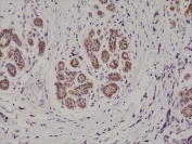 IHC testing of formalin fixed and paraffin embedded human breast cancer tissue with recombinant S100B antibody at 1:1000 dilution. HIER: steam section in pH6 citrate buffer for 20 min and allow to cool prior to staining.