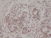 IHC testing of formalin fixed and paraffin embedded human breast cancer tissue with recombinant CD56 antibody at 1:500 dilution. HIER: steam section in pH6 citrate buffer for 20 min and allow to cool prior to staining.