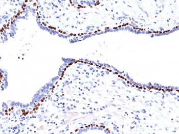 IHC testing of FFPE human prostate tissue with recombinant p63 antibody. HIER: boil tissue sections in pH6, 10mM citrate buffer, for 10-20 min and allow to cool before testing.