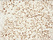 IHC staining of FFPE mouse xenograft LNCaP95 tumor tissue sections with recombinant Androgen Receptor antibody at 1:2000. Courtesy of Dr. Stephen Plymate, University of Washington, Washington USA.