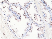 IHC staining of FFPE human prostate cancer tissue with recombinant Androgen Receptor antibody at 1:200.