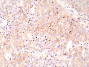 IHC staining of FFPE human lung cancer tissue with recombinant PD-L1 antibody at 1:1000.