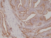 IHC staining of FFPE human prostate cancer tissue with recombinant PSMA antibody at 1:1000.