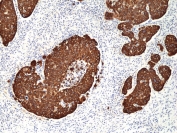 IHC staining of FFPE human cervical squamouscell carcinoma tissue with recombinant Cytokeratin 14 antibody at 1:2000.