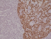 IHC staining of FFPE human tonsil tissue with recombinant Cytokeratin 14 antibody at 1:2000.