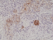 IHC staining of FFPE human melanoma tissue with recombinant MART1 antibody at 1:1000.