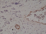 IHC staining of FFPE human breast cancer tissue with recombinant CD10 antibody at 1:200.