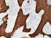 IHC staining of FFPE human lung squamous cell carcinoma tissue with recombinant Cytokeratin 5/6 antibody at 1:1000.