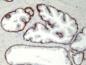 IHC staining of FFPE human prostate tissue with recombinant Cytokeratin 5/6 antibody at 1:1000.