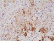 IHC staining of FFPE human lung cancer tissue with recombinant Cyclooxygenase 2 antibody at 1:1000.