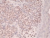 IHC staining of FFPE human melonoma tissue with recombinant IRF4 antibody at 1:250.