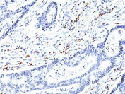 IHC staining of FFPE human colon cancer tissue with recombinant CD5 antibody at 1:1000.