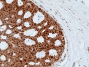 IHC staining of FFPE human breast cancer tissue with recombinant BAG-1 antibody at 1:500.