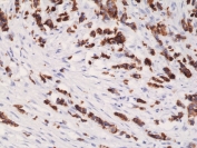 IHC staining of FFPE human breast cancer tissue with recombinant Cytokeratin 19 antibody at 1:1000.