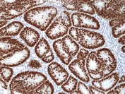 IHC staining of FFPE human colon cancer tissue with recombinant SATB2 antibody at 1:1000.