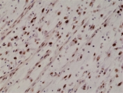 IHC staining of FFPE human Rhabdomyosarcoma tissue with recombinant Myogenin D1 antibody at 1:1000.