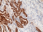 IHC staining of FFPE human lung cancer tissue with recombinant SP-B antibody at 1:1000.