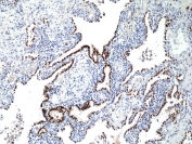 IHC staining of FFPE human lung cancer tissue with recombinant Thyroid transcription factor 1 antibody at 1:500.