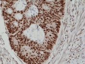 IHC staining of FFPE human colon cancer tissue with recombinant MSH2 antibody at 1:200.