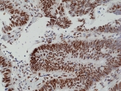 IHC staining of FFPE human colon cancer tissue with recombinant MSH6 antibody at 1:100.