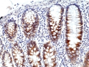 IHC staining of FFPE human colon cancer tissue with recombinant Transferrin Receptor antibody at 1:500.