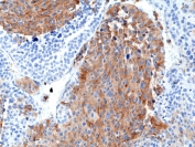 IHC staining of FFPE human medullary thyroid carcinoma tissue with recombinant Chromogranin A antibody at 1:2500.