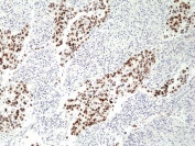 IHC staining of FFPE human lung cancer tissue with recombinant p53 antibody at 1:100.