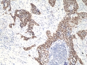 IHC staining of FFPE human lung squamouscarcinoma tissue with recombinant deltaNp63 antibody at 1:50.