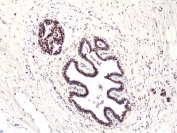 IHC staining of FFPE human breast ductal carcinoma tissue with recombinant FOXP1 antibody at 1:200.