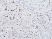 IHC staining of FFPE human cholangiocarcinoma tissue with recombinant Myeloperoxidase antibody at 1:100.