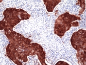 IHC staining of FFPE human cervical squamous carcinoma tissue with recombinant CDKN2A antibody at 1:200.