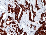 IHC staining of FFPE human lung adenocarcinoma tissue with recombinant Keratin 7 antibody at 1:100.