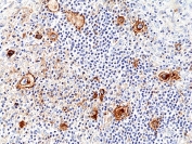 IHC staining of FFPE human Hodgkin lymphoma tissue with recombinant IL2RA antibody at 1:200.
