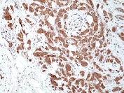 IHC staining of FFPE human breast ductal carcinoma tissue with recombinant MSI2 antibody at 1:400.