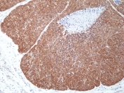 IHC staining of FFPE human esophageal squamous carcinoma tissue with recombinant MSI2 antibody at 1:100.
