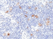 IHC staining of FFPE human Hodgkins lymphoma tissue with recombinant CD30 antibody at 1:100.