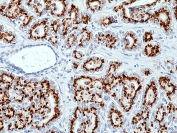 IHC staining of FFPE human prostate cancer tissue with recombinant Prostein antibody at 1:100.
